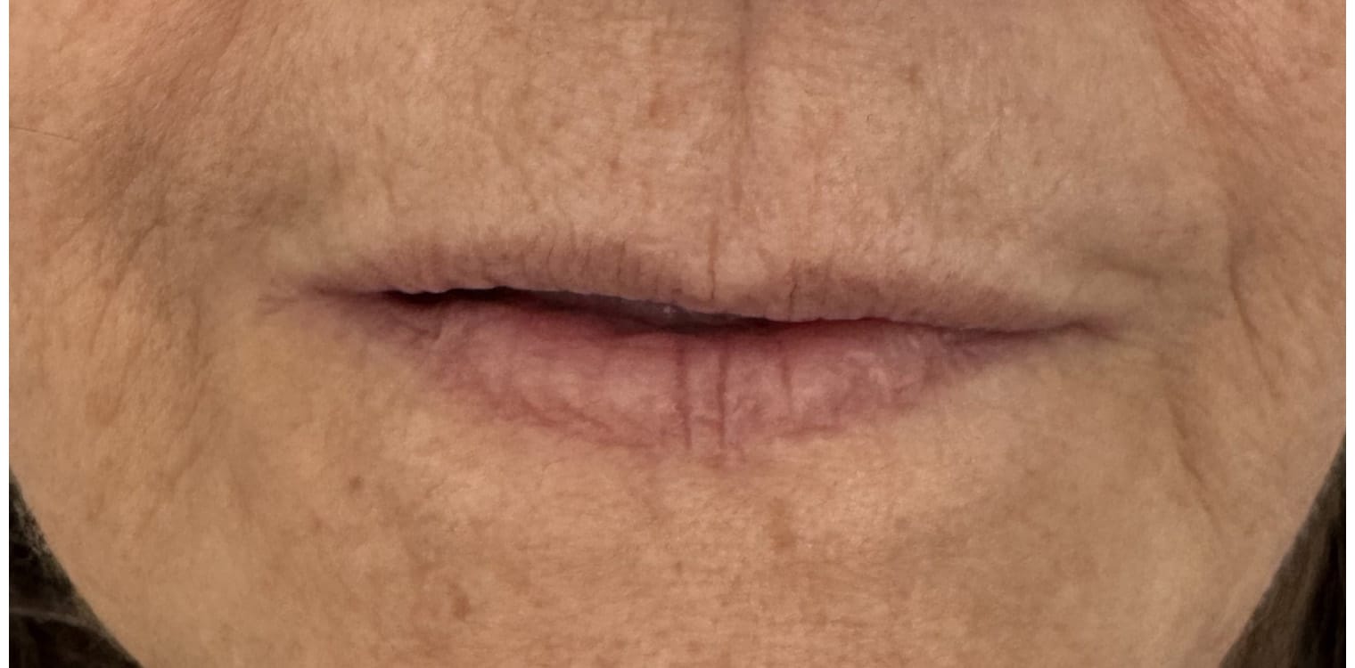 Before Image: Lip Filler - front