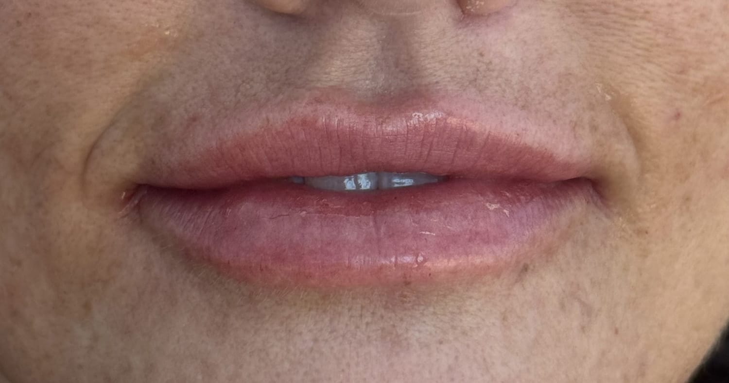 After Image: Lip Filler - front