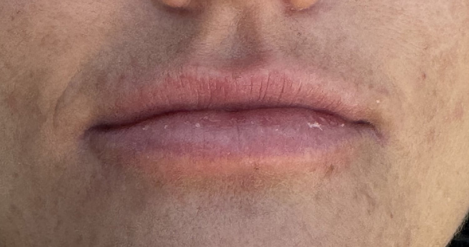 Before Image: Lip Filler - front