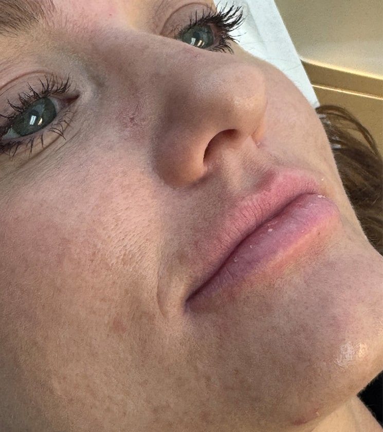 Before Image: Lip Filler - right-front-oblique