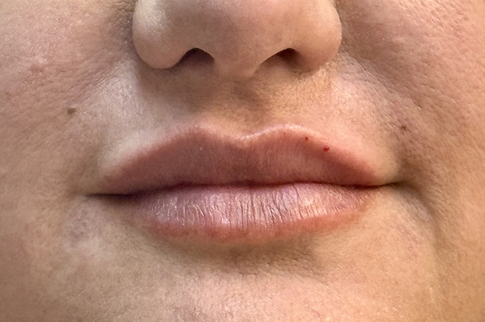 After Image: Lip Filler - front