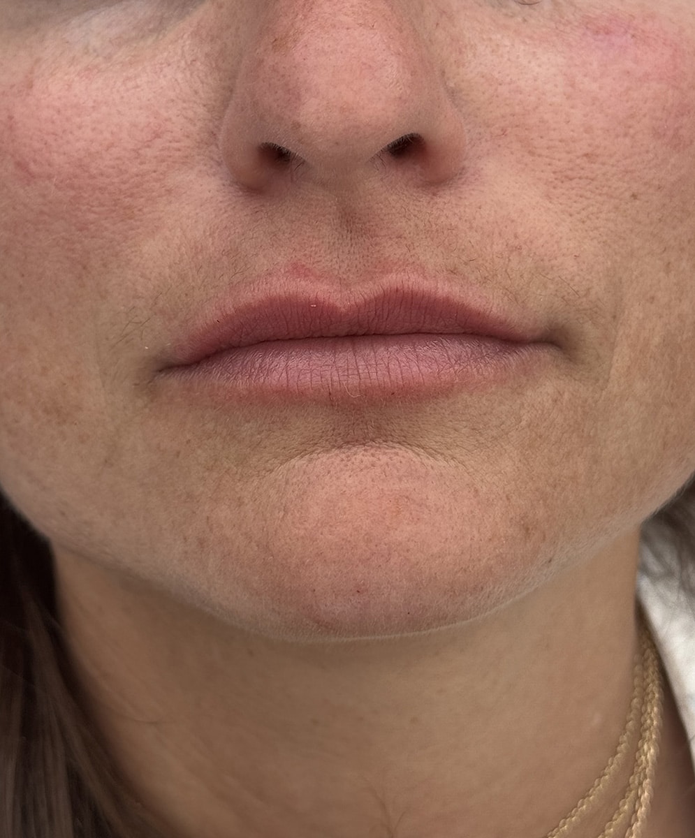 After Image: Lip Filler - front