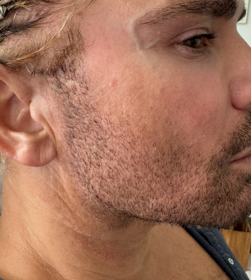 After Image: Jawline - right-side