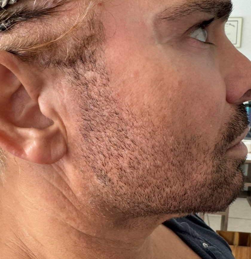 Before Image: Jawline - right-side