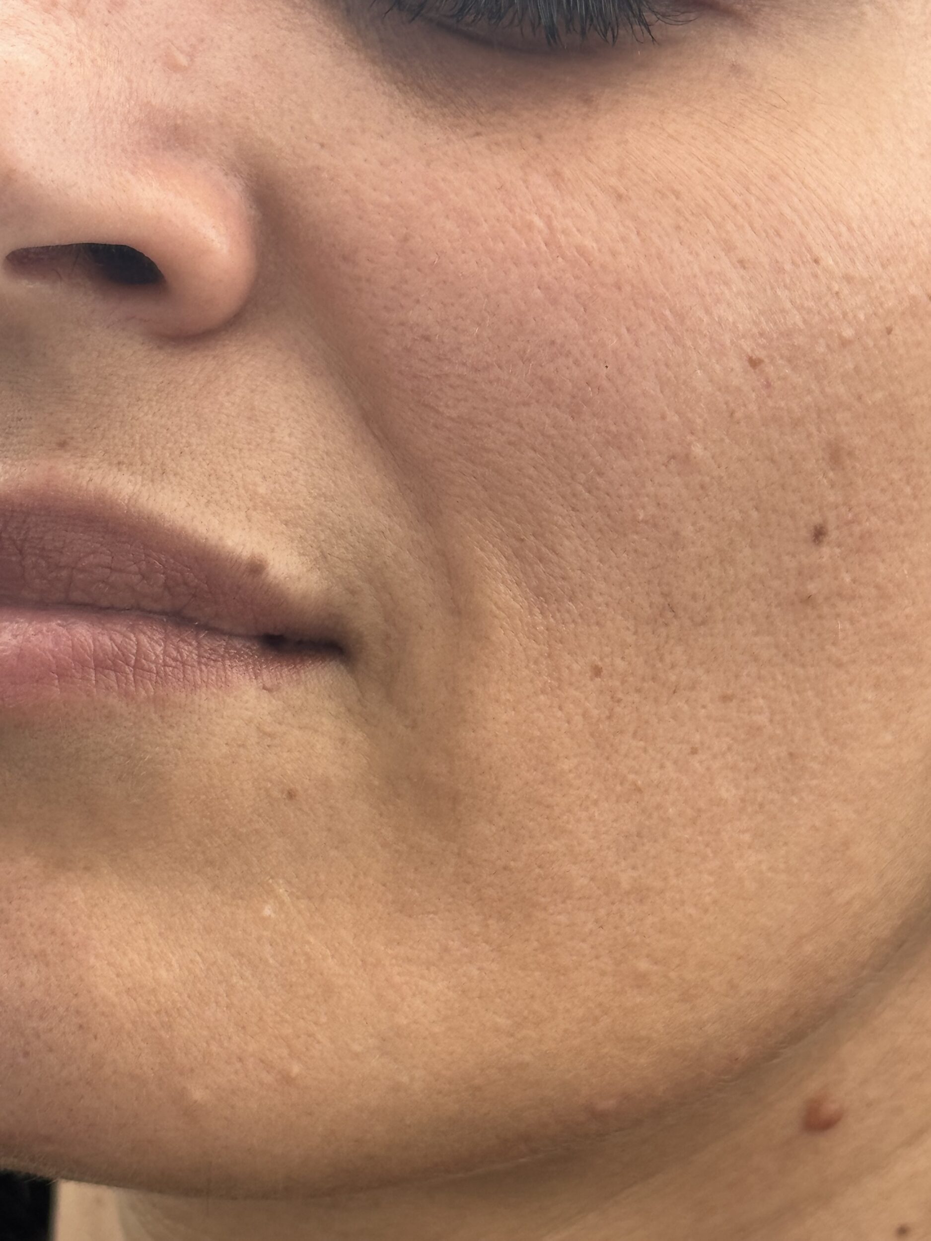 After Image: Filler - left-front-oblique