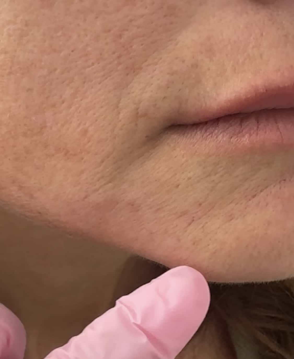 Before Image: Filler - right-front-oblique