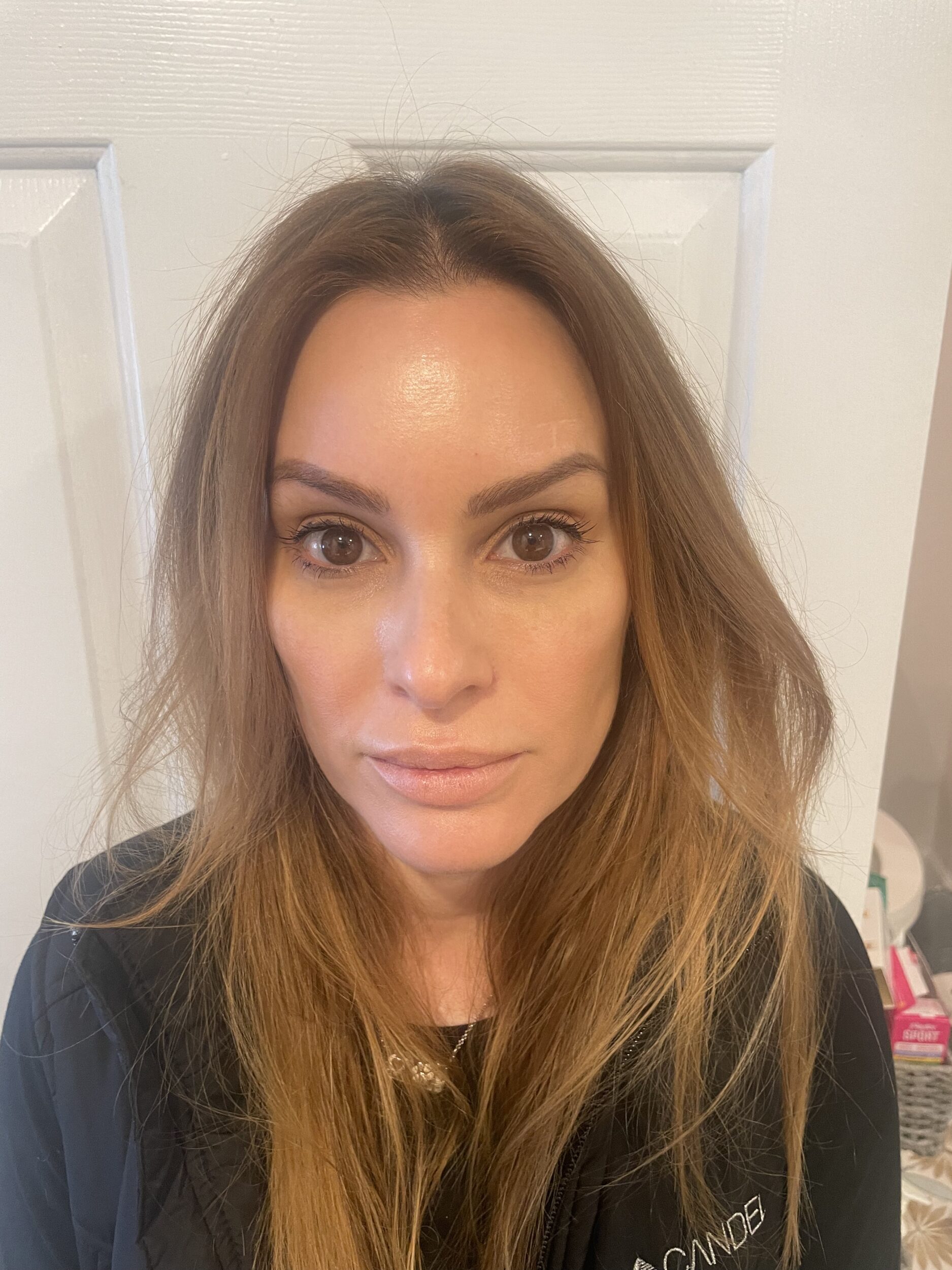 After Image: Botox - front