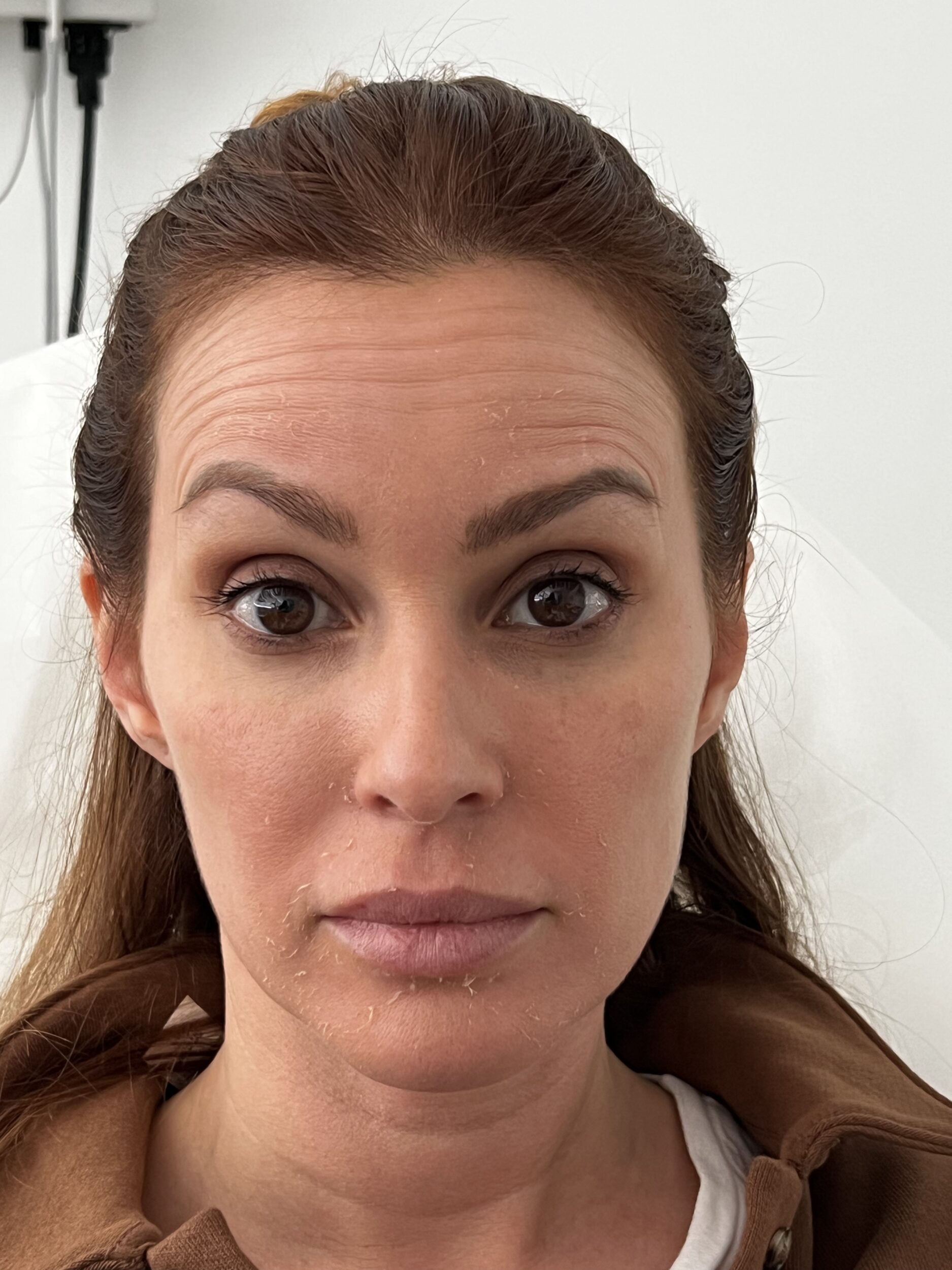 Before Image: Botox - front