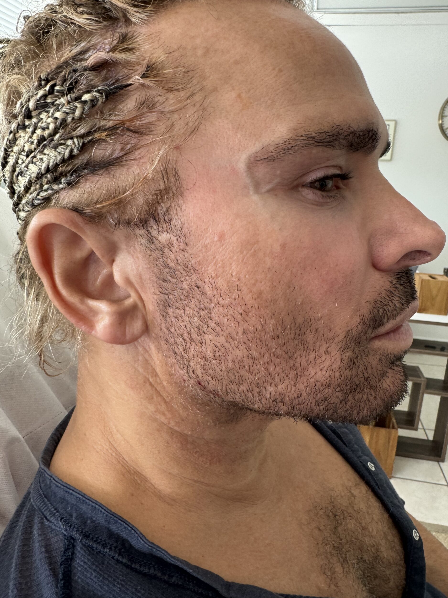 After Image: Jawline - right-side